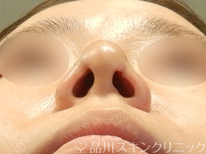症例NO.70098のAFTER写真