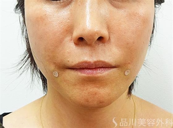 症例NO.32824のAFTER写真