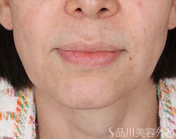 症例NO.74065のBEFORE写真