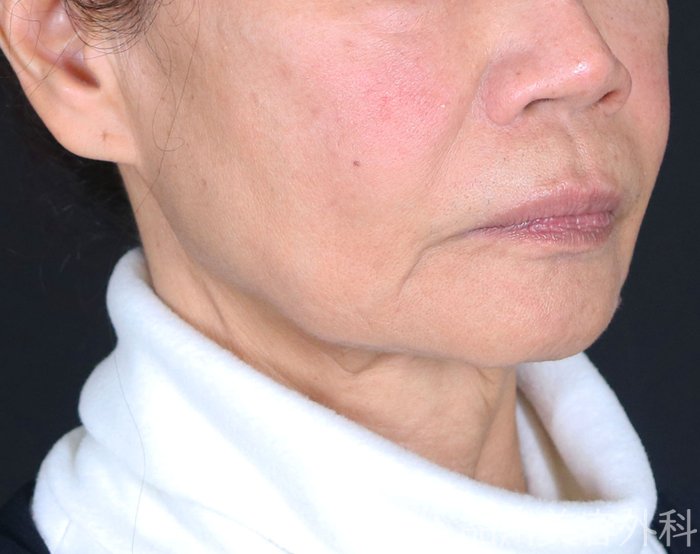 症例NO.72515のBEFORE写真