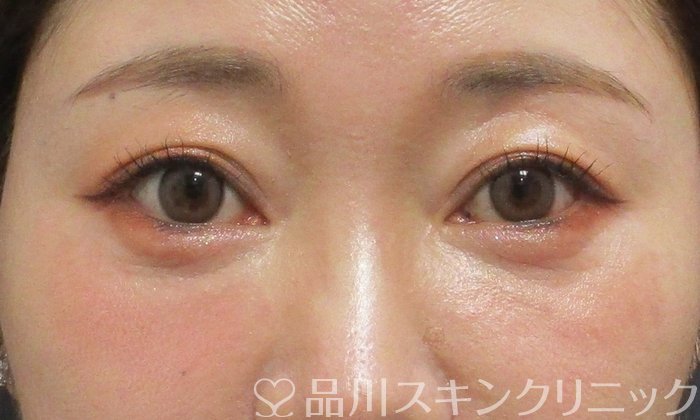 症例NO.70362のAFTER写真