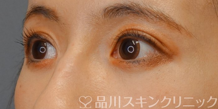 症例NO.75253のAFTER写真