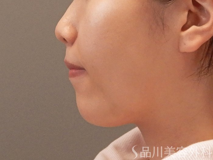 症例NO.70050のBEFORE写真
