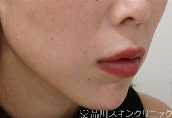 症例NO.37530のAFTER写真