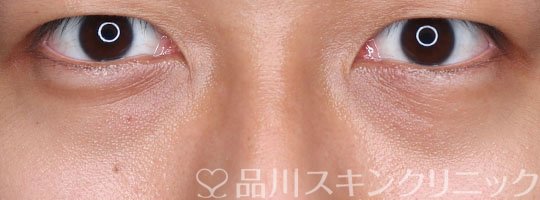 症例NO.70518のBEFORE写真