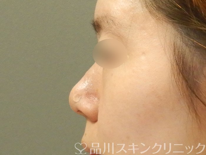 症例NO.70098のAFTER写真