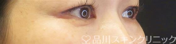 症例NO.59882のBEFORE写真