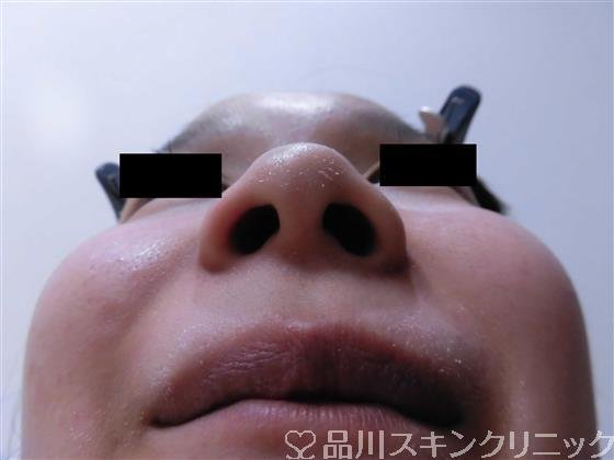 症例NO.34921のBEFORE写真