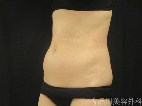 症例NO.51652のBEFORE写真