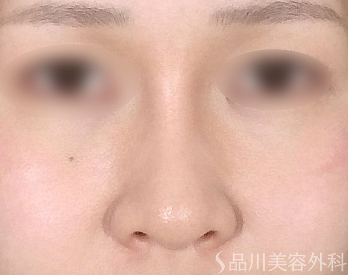 症例NO.64781のAFTER写真