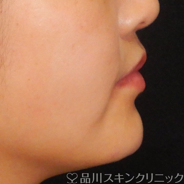 症例NO.64088のAFTER写真