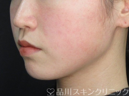 症例NO.71549のBEFORE写真