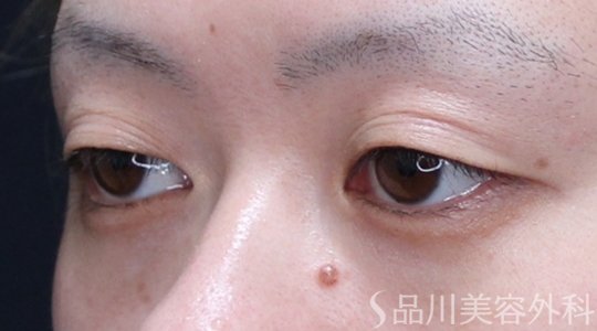 症例NO.74876のBEFORE写真