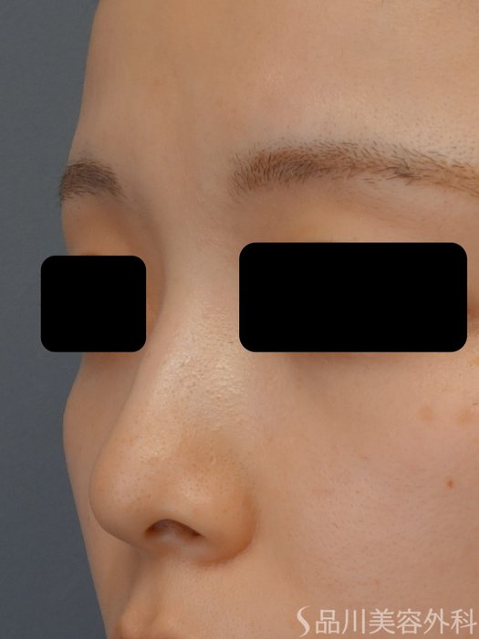 症例NO.74055のBEFORE写真