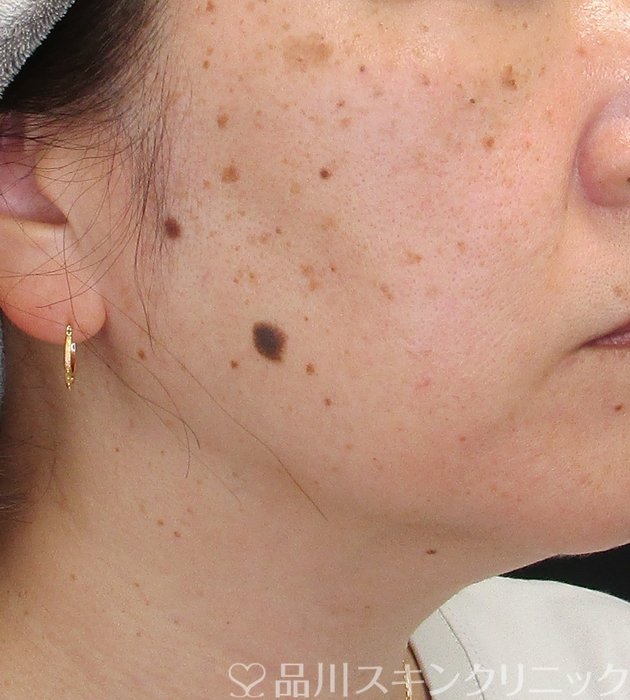 症例NO.73187のBEFORE写真