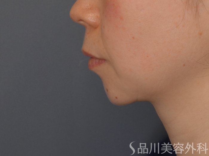 症例NO.69339のBEFORE写真