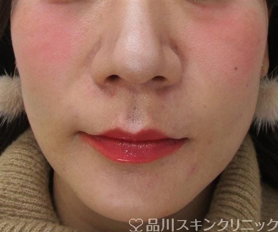 症例NO.45330のAFTER写真