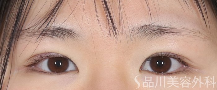 症例NO.72924のAFTER写真