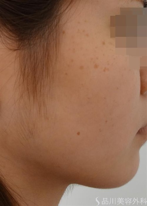 症例NO.25954のBEFORE写真