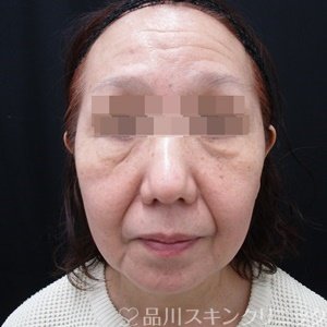 症例NO.67721のBEFORE写真