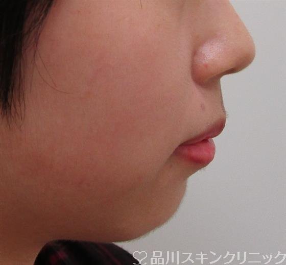 症例NO.30724のBEFORE写真