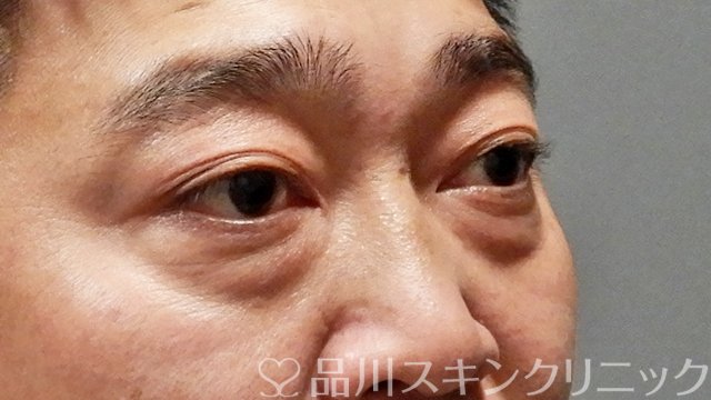 症例NO.65294のBEFORE写真