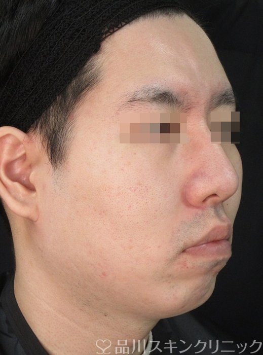 症例NO.72307のAFTER写真