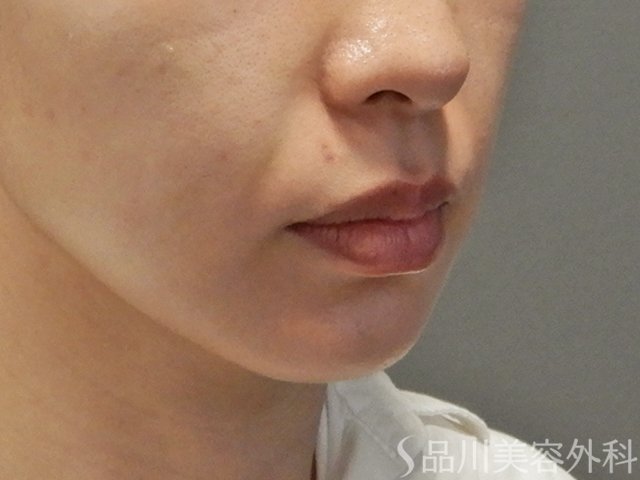 症例NO.74654のBEFORE写真