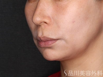 症例NO.74303のAFTER写真