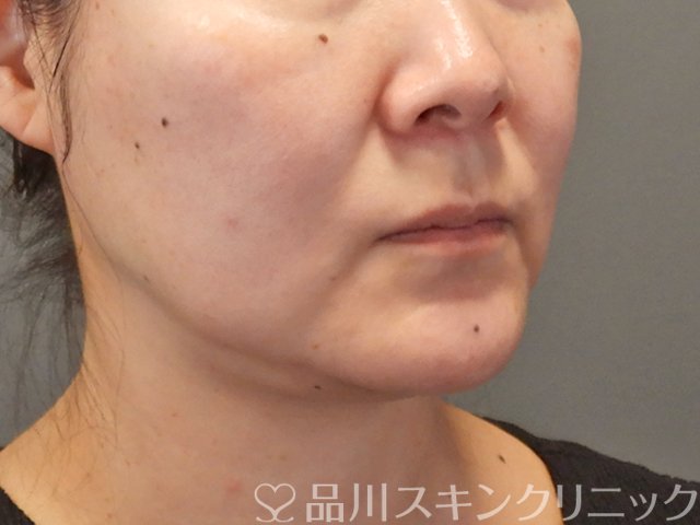 症例NO.75317のBEFORE写真