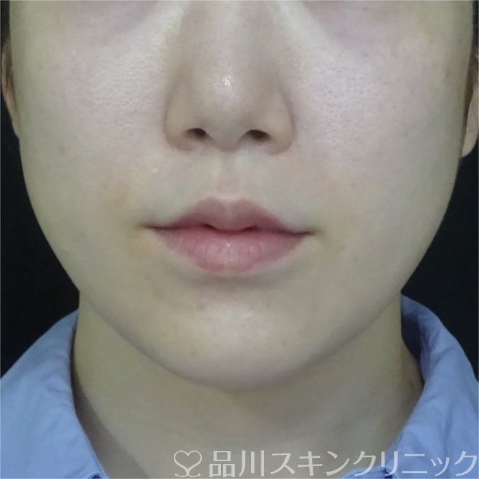 症例NO.70902のBEFORE写真