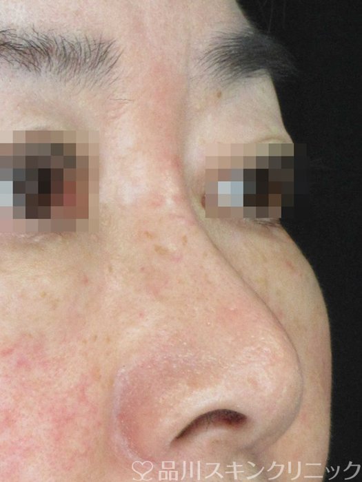 症例NO.69283のBEFORE写真