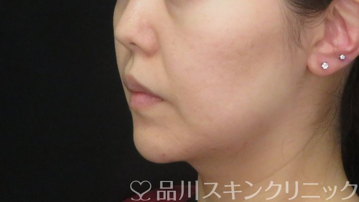 症例NO.72624のAFTER写真