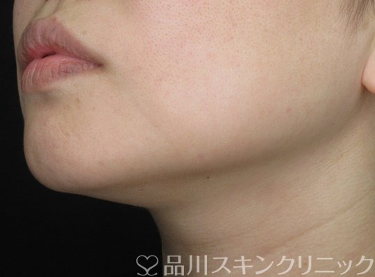症例NO.70169のAFTER写真