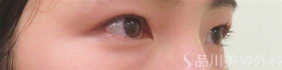 症例NO.53922のBEFORE写真