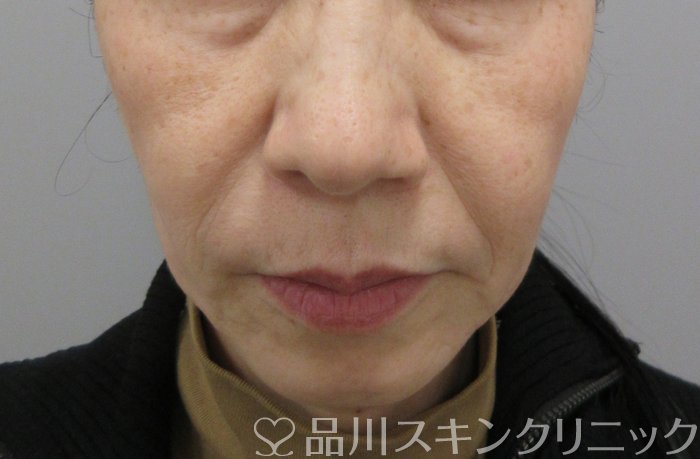 症例NO.70086のBEFORE写真