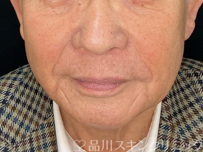 症例NO.73042のBEFORE写真