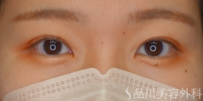 症例NO.73236のAFTER写真