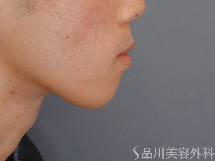 症例NO.70593のBEFORE写真