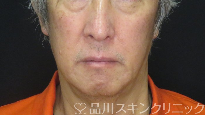 症例NO.73480のBEFORE写真