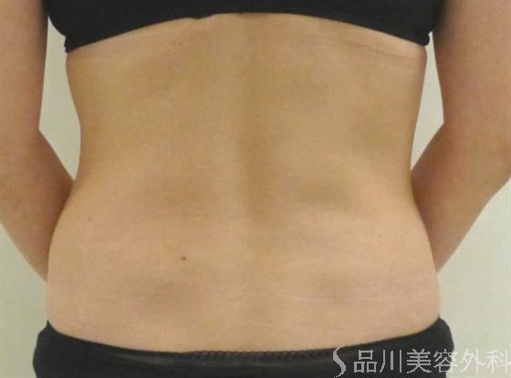 症例NO.43172のBEFORE写真