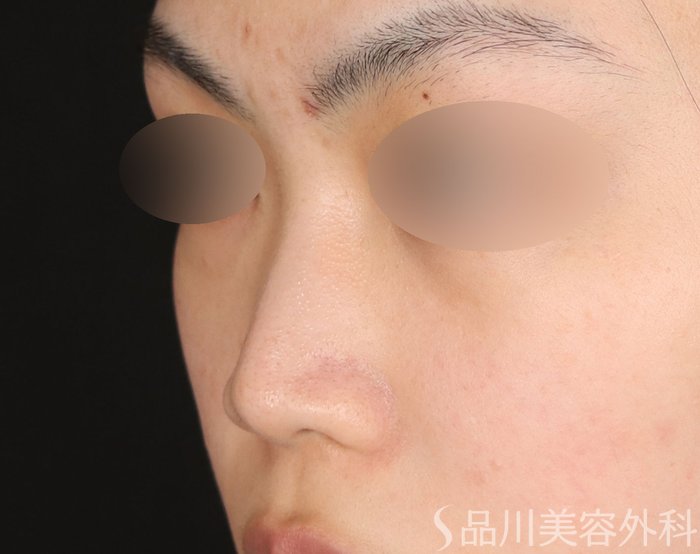 症例NO.72356のBEFORE写真