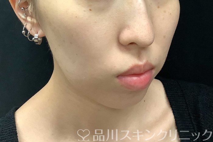 症例NO.69775のBEFORE写真