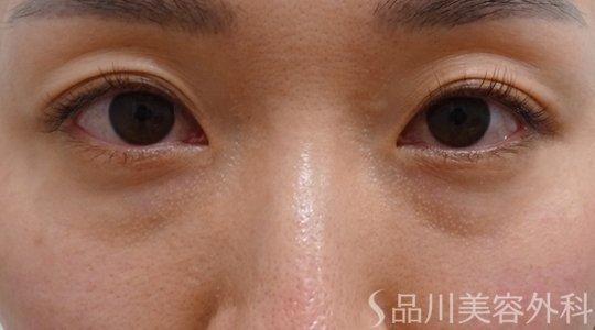 症例NO.71759のBEFORE写真