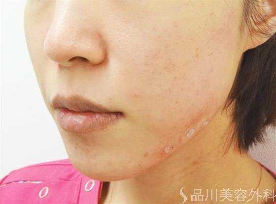 症例NO.32826のAFTER写真