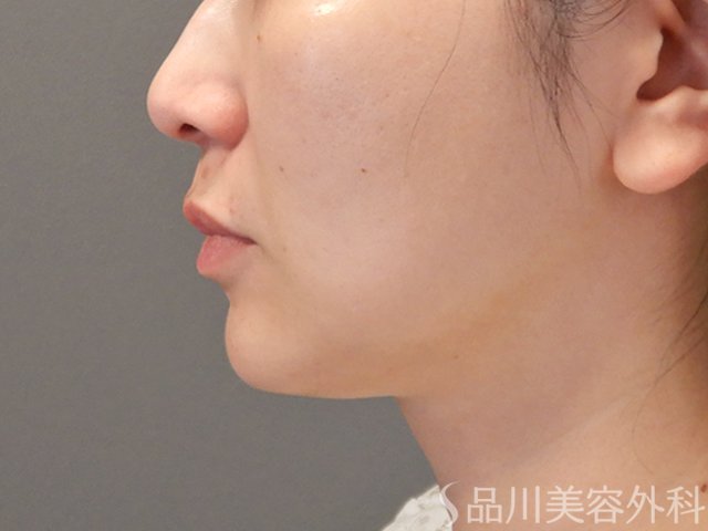 症例NO.74922のBEFORE写真