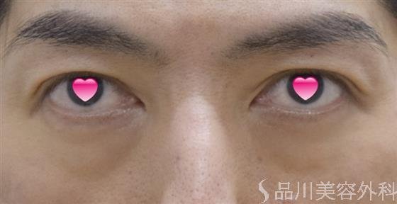 症例NO.51670のBEFORE写真