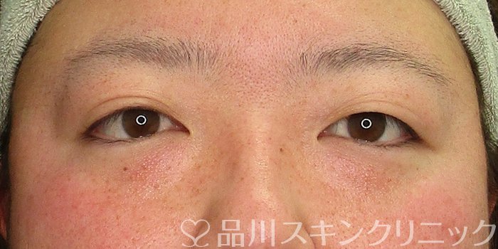 症例NO.69877のBEFORE写真