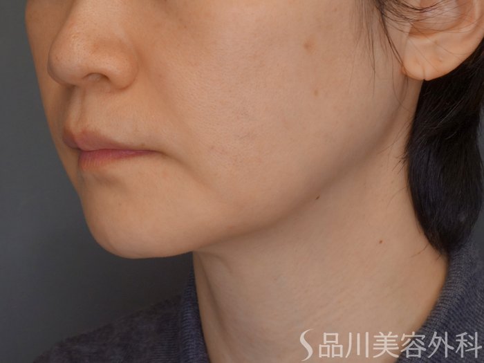 症例NO.72440のBEFORE写真