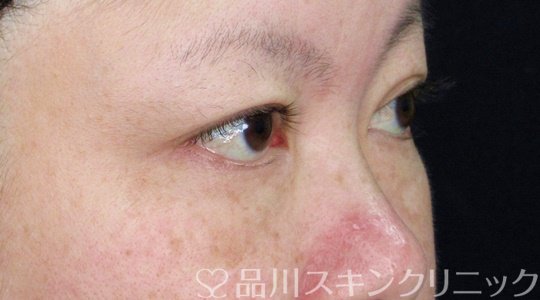 症例NO.71722のBEFORE写真